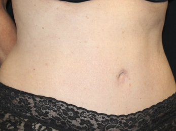 Tummy Tuck Before & After Patient #28029