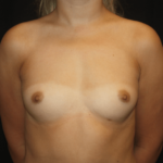 Breast Augmentation - Round Silicone Implants Before & After Patient #28323