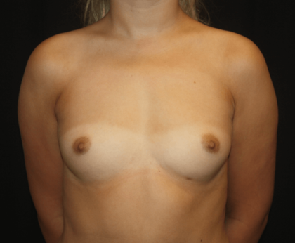 Breast Augmentation - Round Silicone Implants Before & After Patient #28323