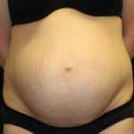 Tummy Tuck Before & After Patient #28312