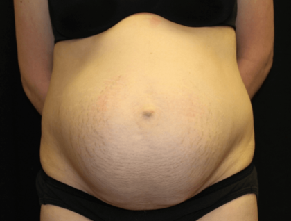 Tummy Tuck Before & After Patient #28312