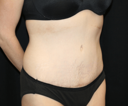 Tummy Tuck Before & After Patient #28312