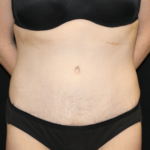 Tummy Tuck Before & After Patient #28312