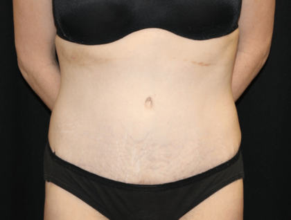 Tummy Tuck Before & After Patient #28312