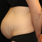 Tummy Tuck Before & After Patient #28312