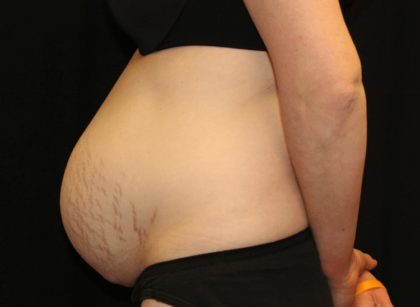 Tummy Tuck Before & After Patient #28312