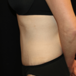 Tummy Tuck Before & After Patient #28312