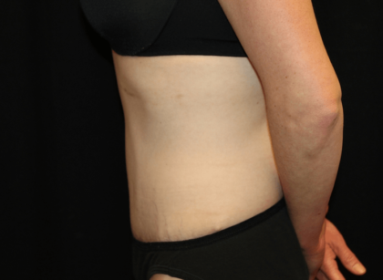 Tummy Tuck Before & After Patient #28312