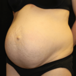 Tummy Tuck Before & After Patient #28312