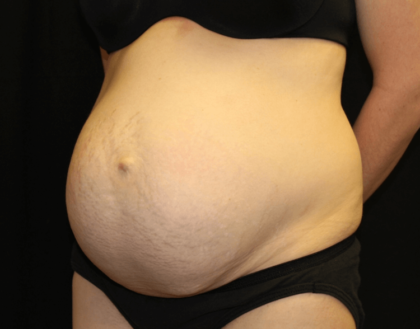 Tummy Tuck Before & After Patient #28312