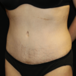 Tummy Tuck Before & After Patient #28312