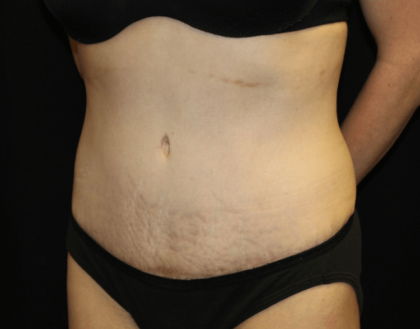 Tummy Tuck Before & After Patient #28312