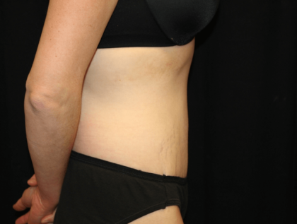 Tummy Tuck Before & After Patient #28312