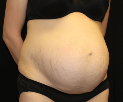 Tummy Tuck Before & After Patient #28312