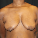 Breast Lift with Implant Before & After Patient #28301
