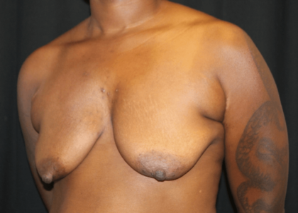 Breast Lift with Implant Before & After Patient #28301