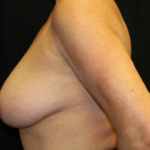 Breast Lift Before & After Patient #28343