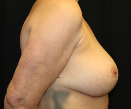 Breast Lift Before & After Patient #28343