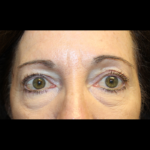 Blepharoplasty Before & After Patient #28334