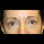 Blepharoplasty Before & After Patient #28334