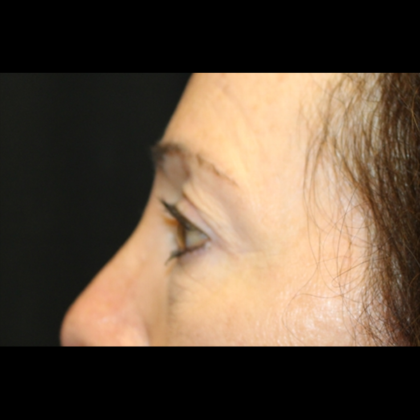 Blepharoplasty Before & After Patient #28334