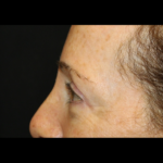 Blepharoplasty Before & After Patient #28334