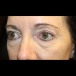 Blepharoplasty Before & After Patient #28334