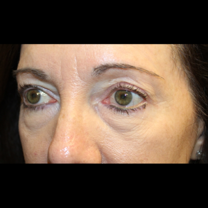 Blepharoplasty Before & After Patient #28334