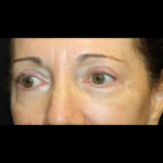 Blepharoplasty Before & After Patient #28334