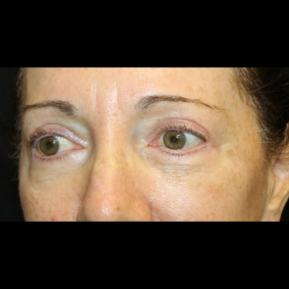 Blepharoplasty Before & After Patient #28334