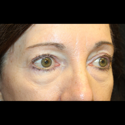 Blepharoplasty Before & After Patient #28334