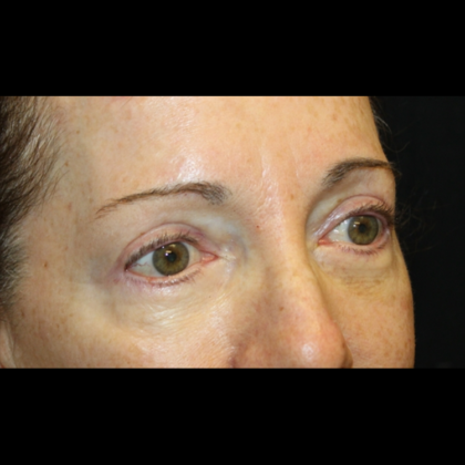 Blepharoplasty Before & After Patient #28334