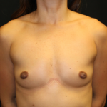 Breast Augmentation - Round Silicone Implants Before & After Patient #28258