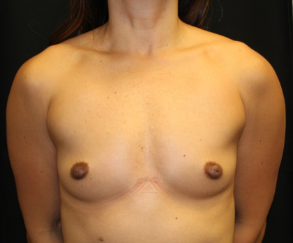 Breast Augmentation - Round Silicone Implants Before & After Patient #28258