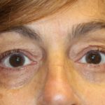 Blepharoplasty Before & After Patient #28251