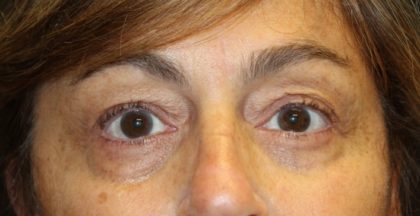 Blepharoplasty Before & After Patient #28251