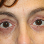 Blepharoplasty Before & After Patient #28251