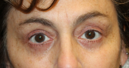 Blepharoplasty Before & After Patient #28251