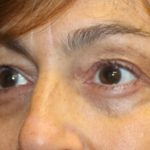 Blepharoplasty Before & After Patient #28251