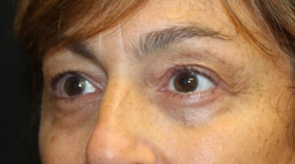 Blepharoplasty Before & After Patient #28251