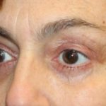 Blepharoplasty Before & After Patient #28251