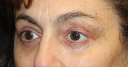 Blepharoplasty Before & After Patient #28251