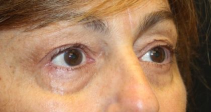 Blepharoplasty Before & After Patient #28251