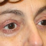 Blepharoplasty Before & After Patient #28251