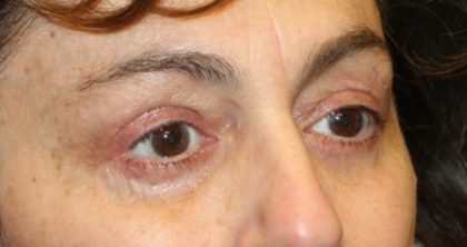 Blepharoplasty Before & After Patient #28251