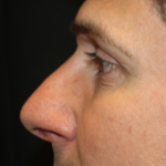 Rhinoplasty Before & After Patient #28285