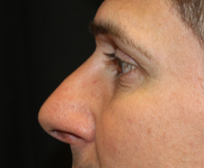 Rhinoplasty Before & After Patient #28285