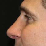 Rhinoplasty Before & After Patient #28285