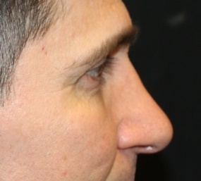 Rhinoplasty Before & After Patient #28285