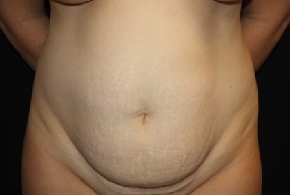 Liposuction Before & After Patient #28240